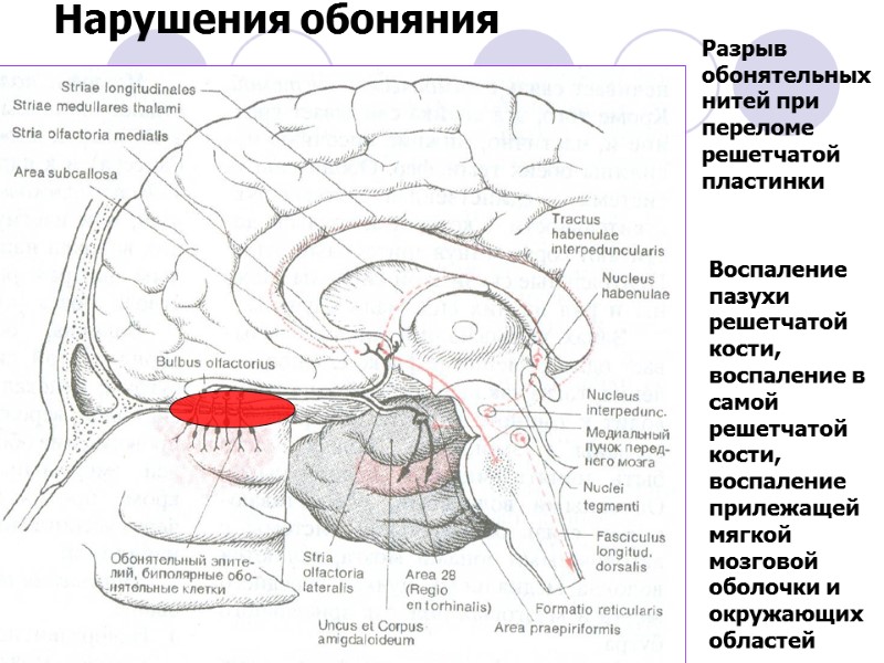 Нарушения обоняния Разрыв обонятельных нитей при переломе решетчатой пластинки Воспаление пазухи решетчатой кости, воспаление
